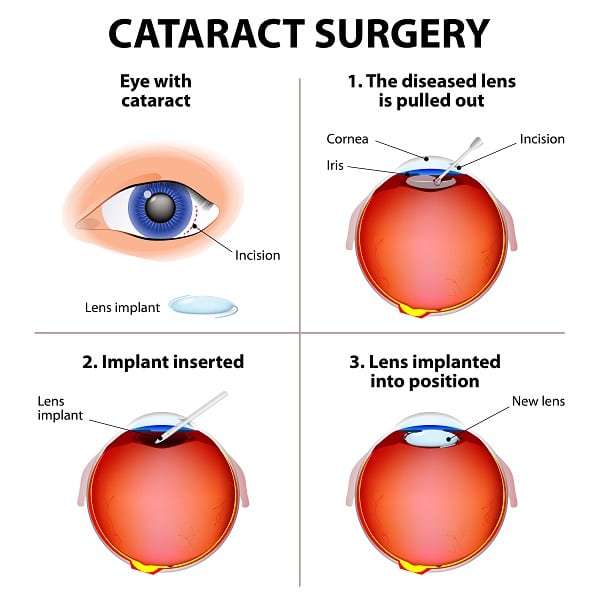 Cataract surgery procedure in Mobile AL