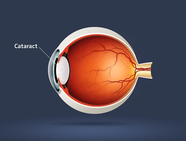 Cataract illustration