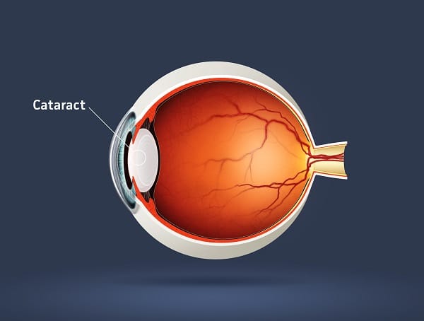 Cataract illustration 